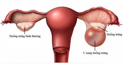 Nguyên nhân gây ra u nang buồng trứng